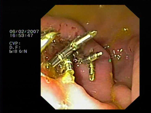 Fig.4 Chiusura della gastrostomia perorale